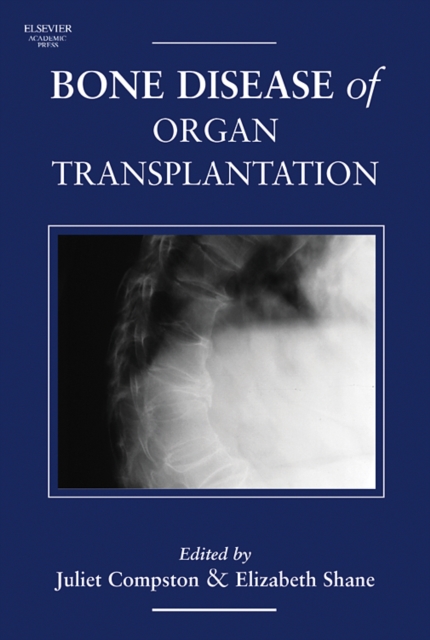 Bone Disease of Organ Transplantation 