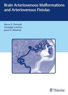 Brain Arteriovenous Malformations and Arteriovenous Fistulas 